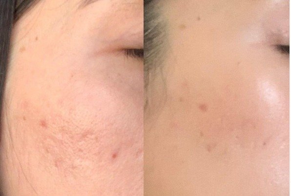 Dermapen
