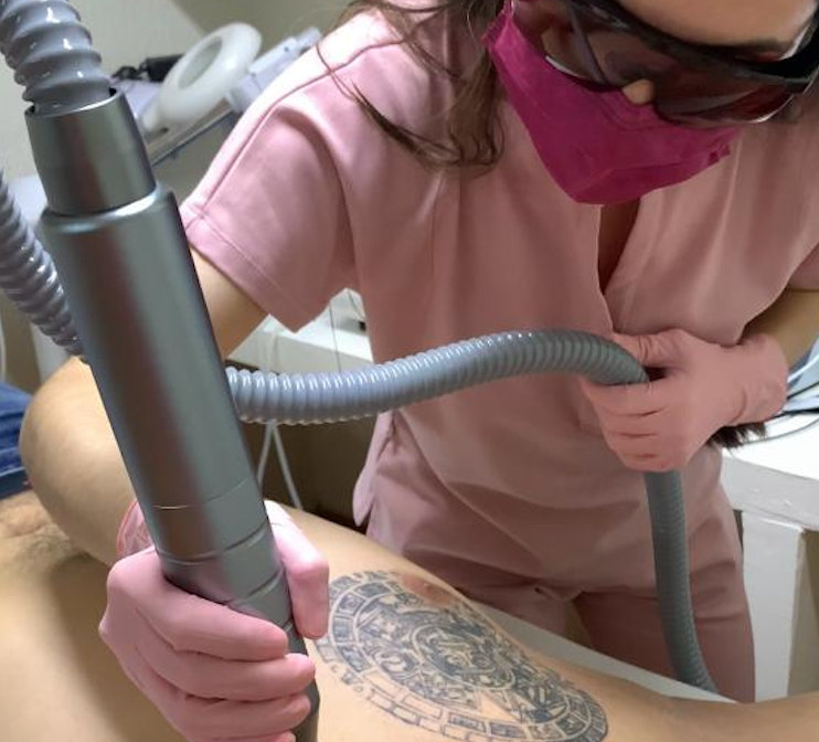 Eliminación de tatuajes