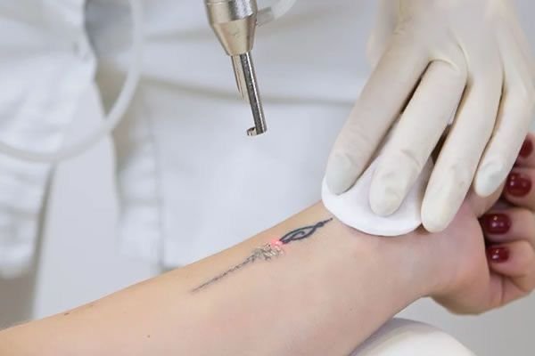 Eliminación de tatuajes
